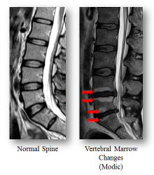 The left MRI photo shows the normal spine without Modic changes; Red arrows on the right photo show Modic changes in the spine.  Through different patterns and levels of Modic changes, low back pain development and severity can be diagnosed.